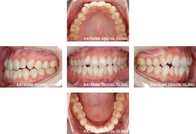 case2 インビザラインを使用して1年と半年矯正をした症例
