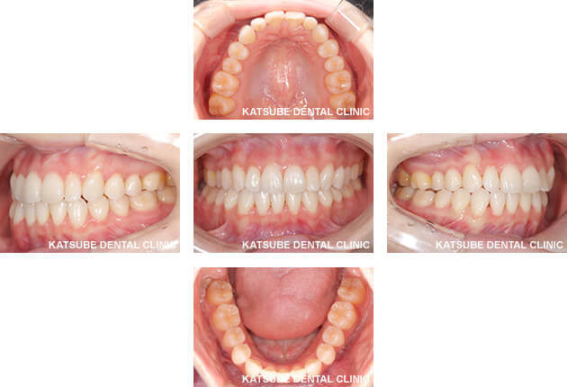 case2 インビザラインを使用して1年と半年矯正をした症例