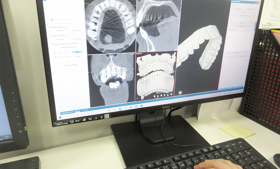 歯・骨・顔・歯根の動きを予測するNemoを採用