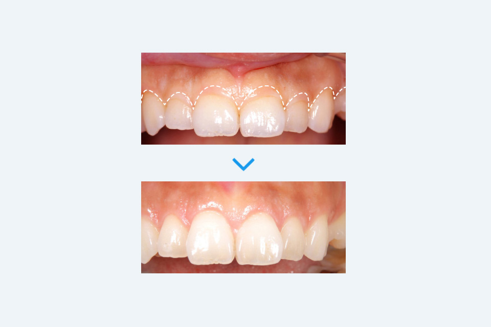 歯肉（歯ぐき）切除による治療