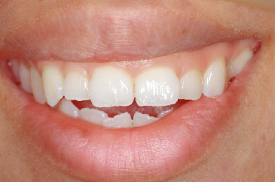 症例2　　歯肉（歯ぐき）切除により治療をした症例