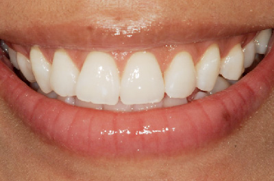 症例3　　歯肉（歯ぐき）切除により治療をした症例