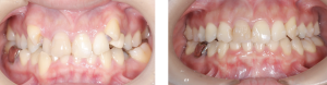 八重歯をマウスピース矯正で5ヶ月歯並び治療