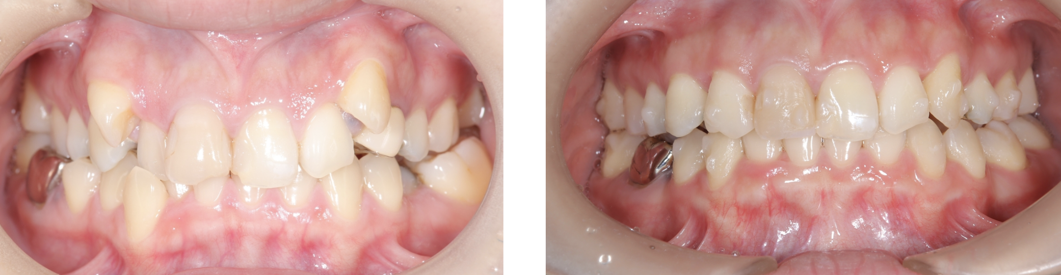 矯正治療の症例