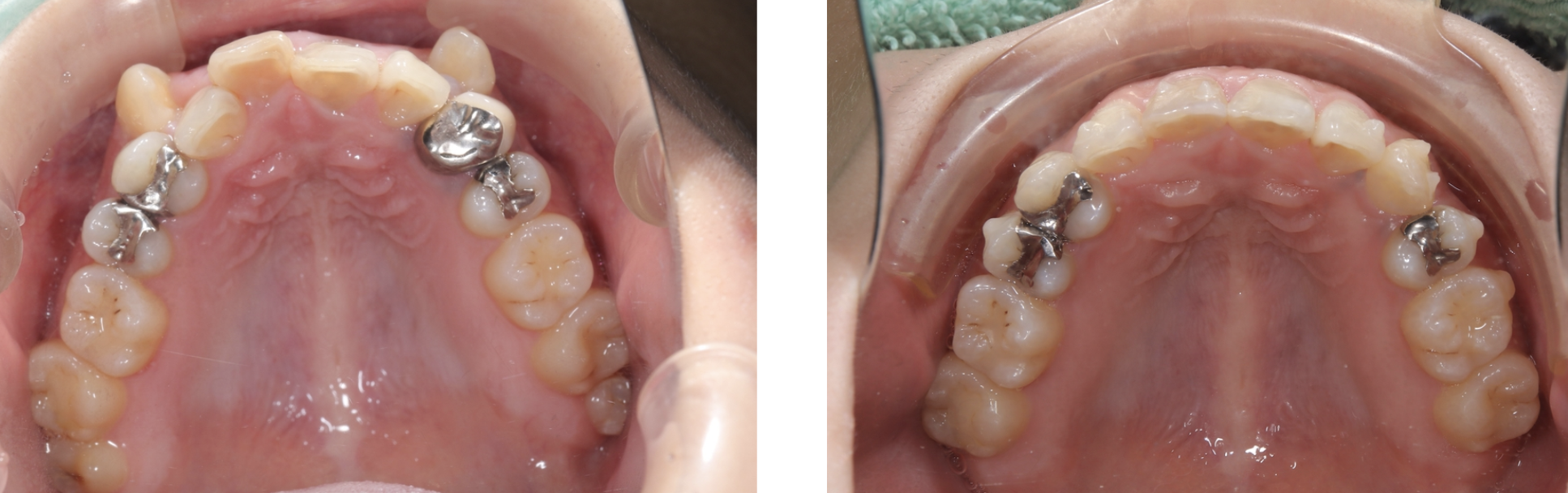 矯正治療の症例