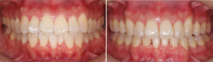 出っ歯を13ヶ月のマウスピース矯正で治療しました