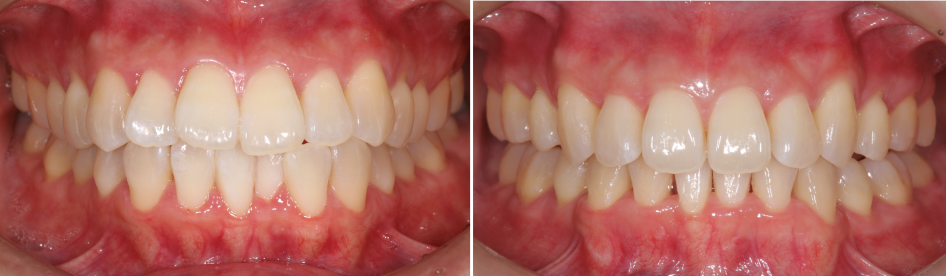 矯正治療の症例